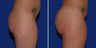 Brazilian Butt Lift
