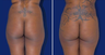 Brazilian Butt Lift