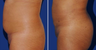 Brazilian Butt Lift