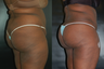 Brazilian Butt Lift