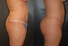 Brazilian Butt Lift