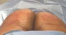 Brazilian Butt Lift