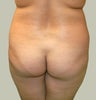 Brazilian Butt Lift with Liposuction