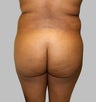 Brazilian Butt Lift