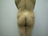 Brazilian Butt Lift