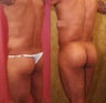 Brazilian buttock augmentation with fat grafting to the buttocks with liposuction in Los Angeles