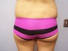 Brazilian Buttlift