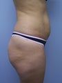Brazilian Butt lift