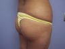 Brazilian Butt lift