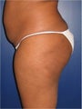 Brazilian Butt Lift
