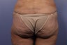 Brazillian Butt lift