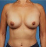 Breast Augmentation