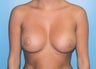 Breast Augmentation - Small B Cup to Small D Cup