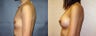 Breast Augmentation