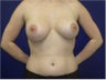 Breast Augmentation