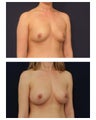 Breast Augmentation