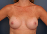 Breast Implants