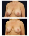 Breast Augmentation with Lift