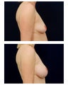 Breast Augmentation
