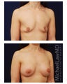 Breast Augmentation