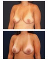 Breast Augmentation