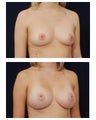 Breast Augmentation