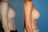 Breast Augmentation Revision
