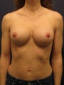 breast augmentation