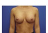 Breast Augmentation