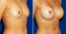 Breast Augmentation