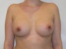 Breast Augmentation (armpit approach)