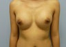 Breast Augmentation