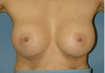 Bilateral Breast Augmentation