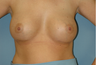 Breast Implants