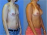 Breast Augmentation