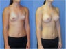 Breast Implants