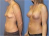 Breast Augmentation