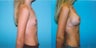 Breast Augmentation