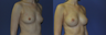 Breast Augmentation