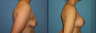 Breast Augmentation
