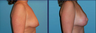 Breast Augmentation