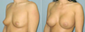 Breast Implants
