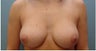 Subfascial Breast Augmentation