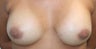 Breast Augmentation