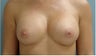 Subfascial Breast Augmentation