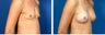 Breast Augmentation