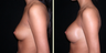 Breast Augmentation