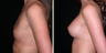 Breast Augmentation 