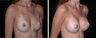 Breast Augmentation