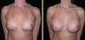 Breast Augmentation 